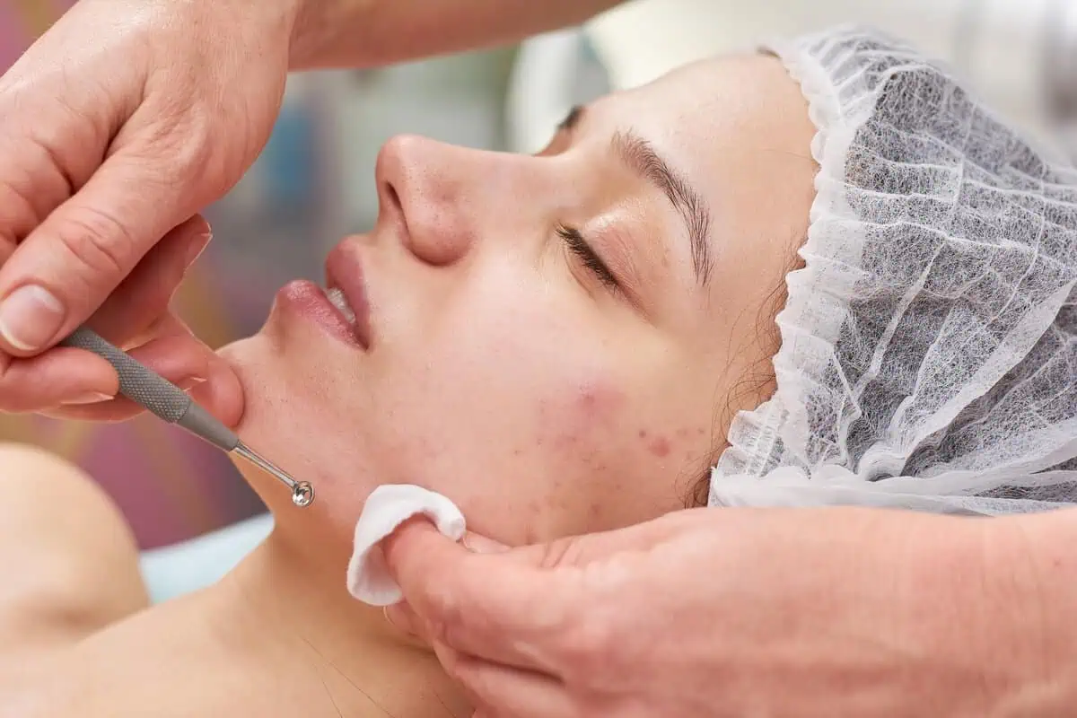 Acne Treatment: Cara Efektif Menghilangkan Jerawat