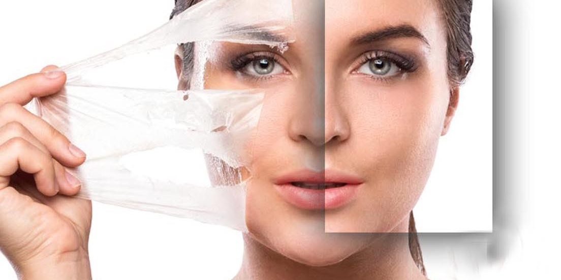 Chemical Peel