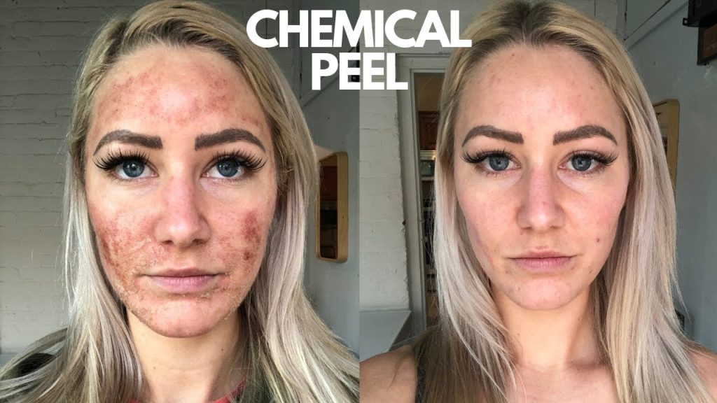 Chemical Peeling