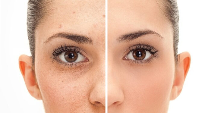 laser fractional