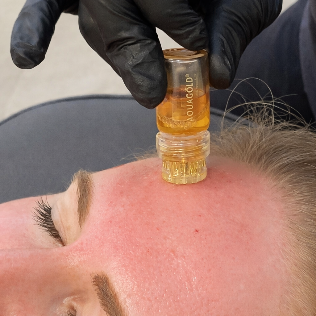 Aquagold Treatment Perawatan Wajah dengan Jarum Emas