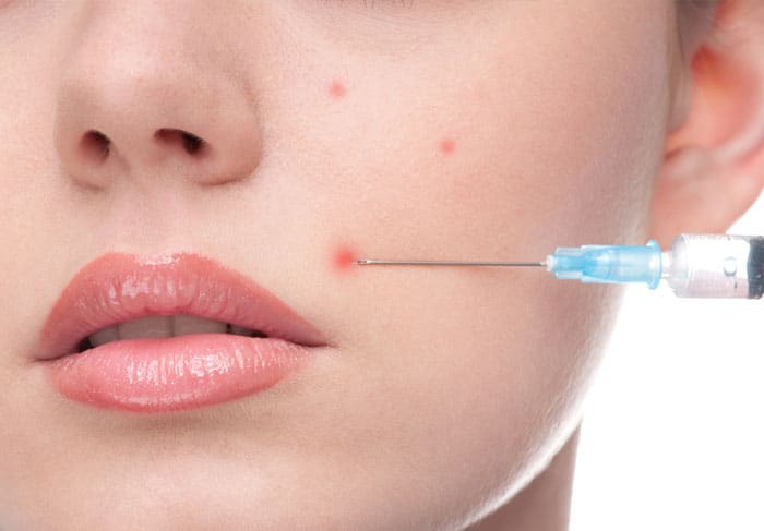 Acne Injection: Solusi Cepat Mengatasi Jerawat Meradang