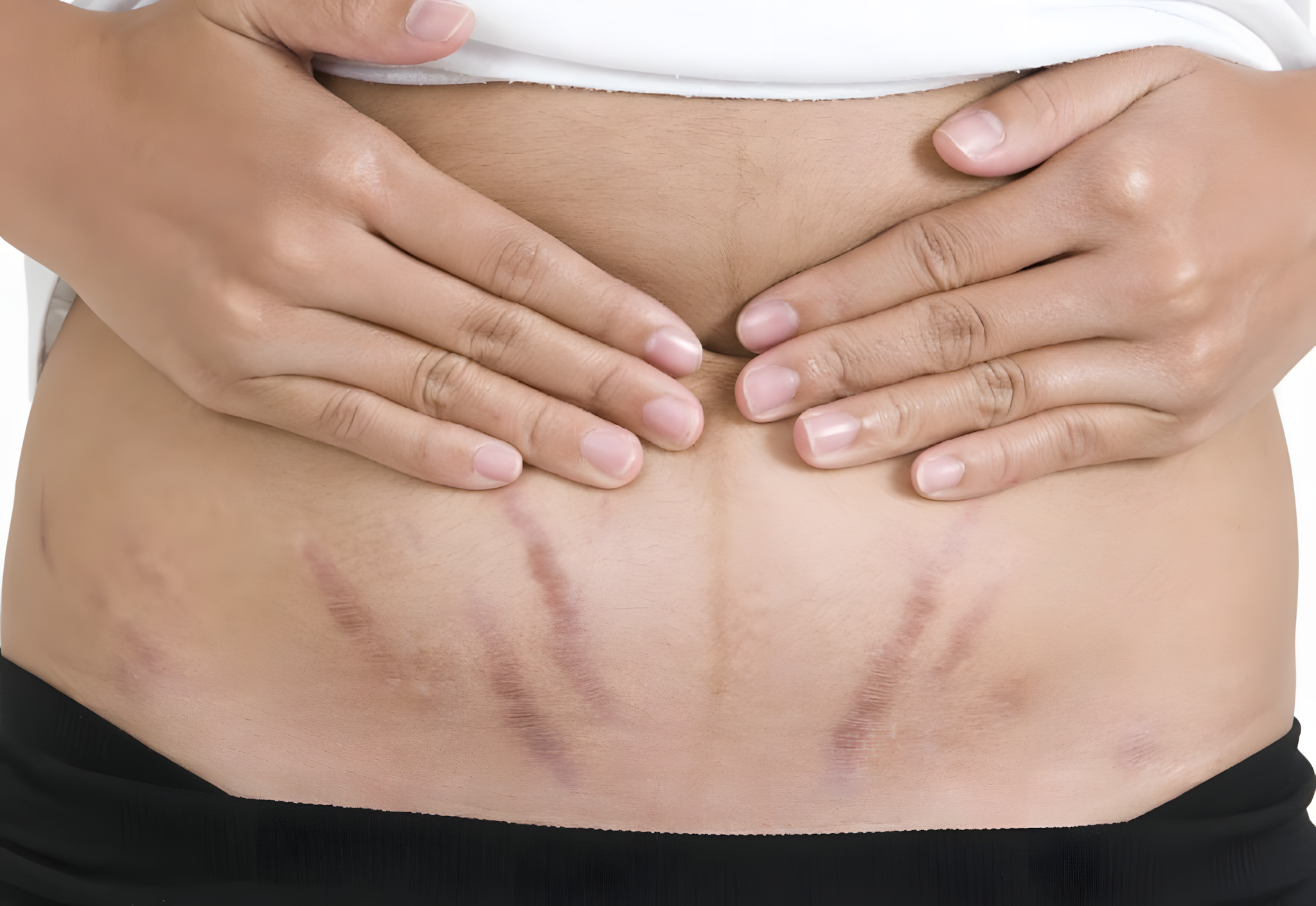 Stretch Mark