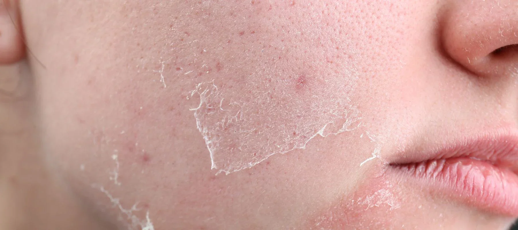 Dead Skin Removal