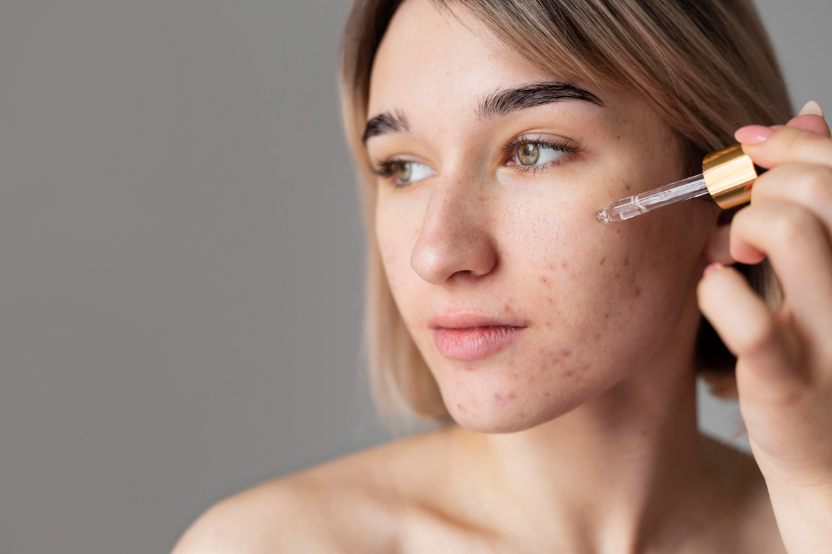 Niacinamide untuk Jerawat