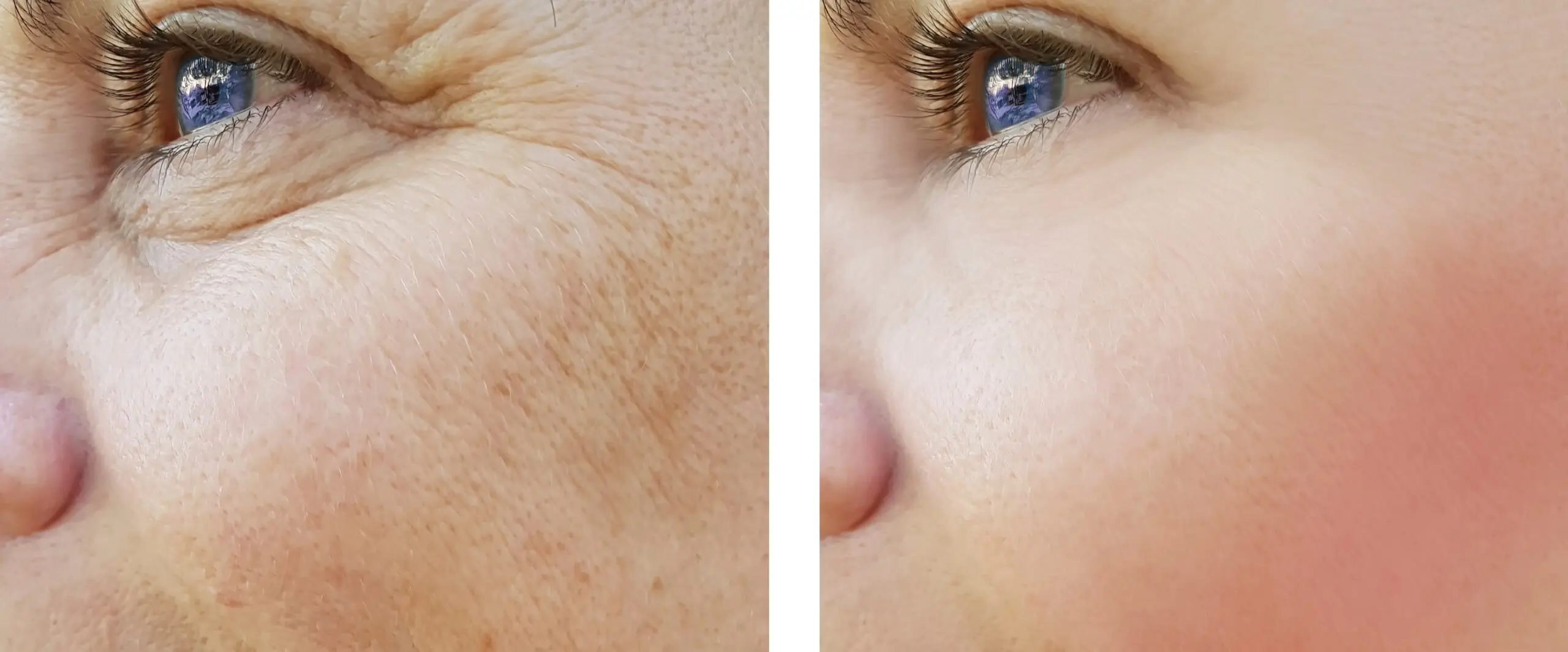 IPL Photorejuvenation