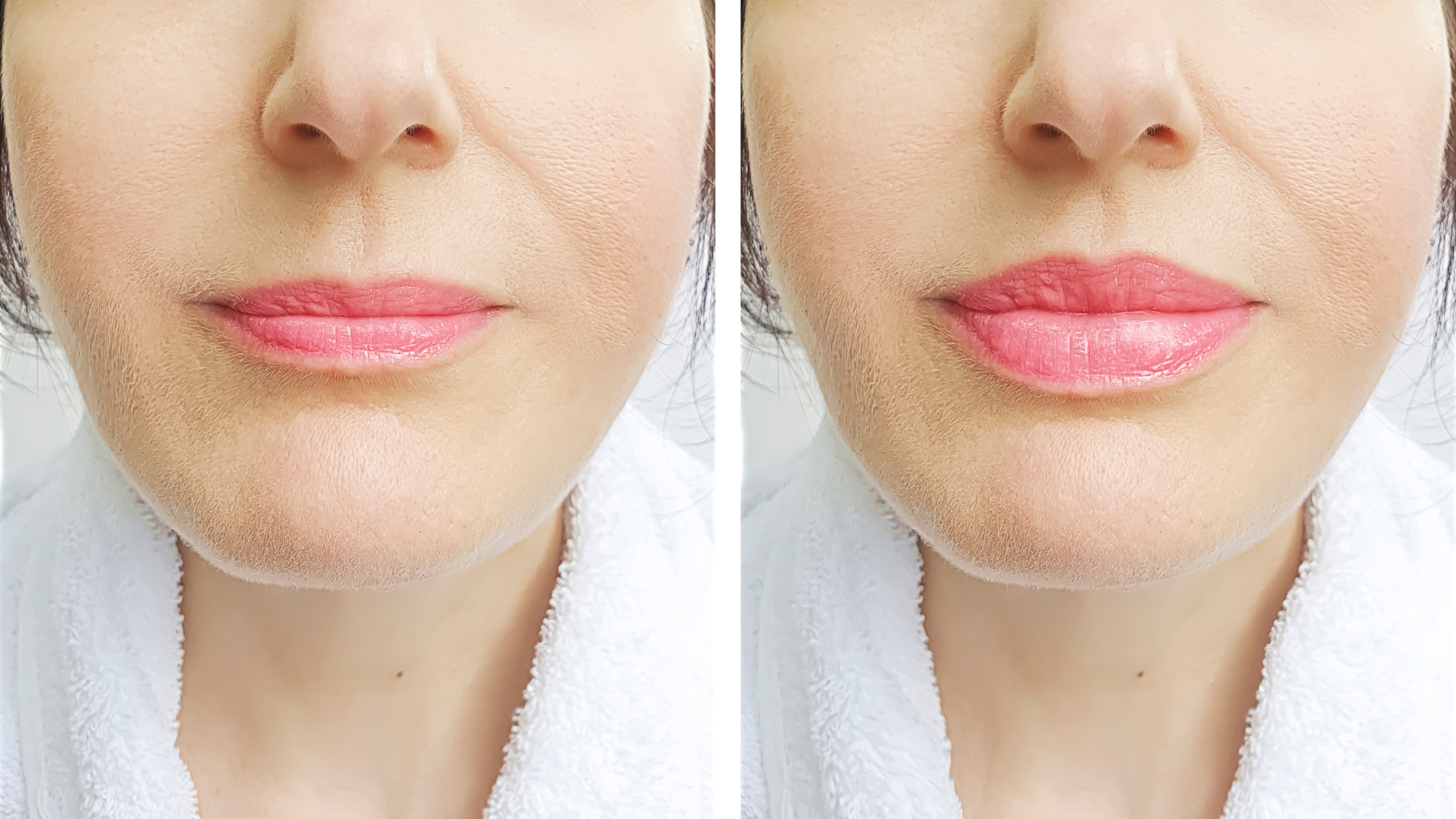 Lip Augmentation