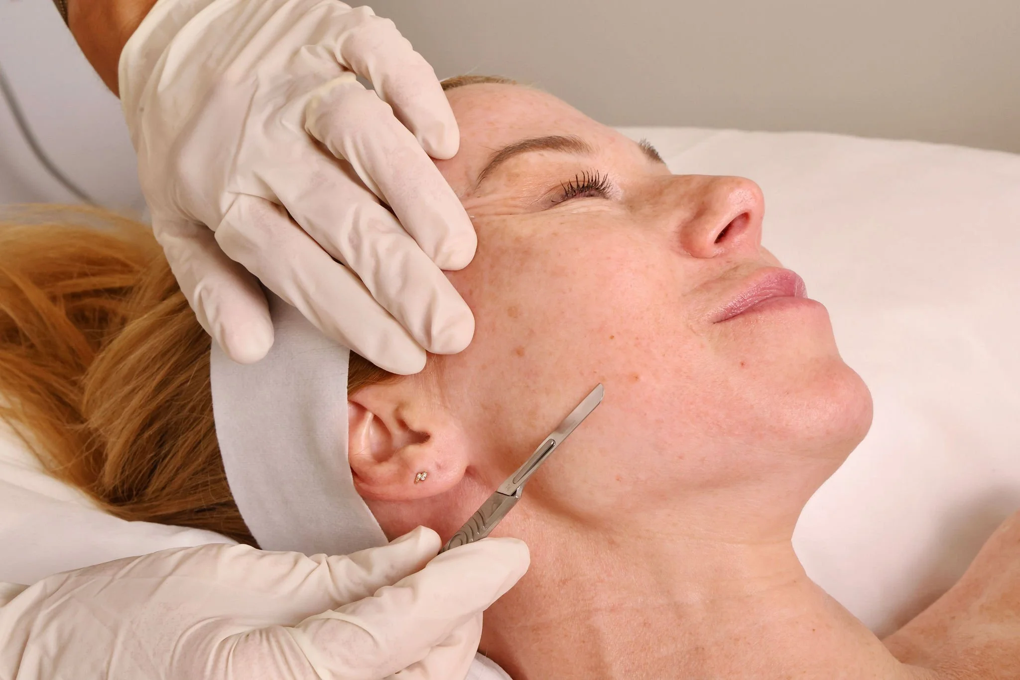 Dermablading: Rahasia Kulit Halus dengan Teknik Eksfoliasi