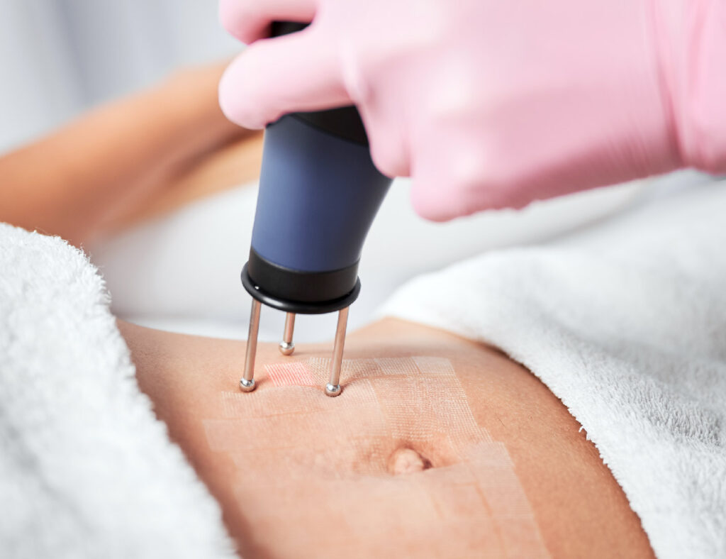 Stretch Mark Treatment