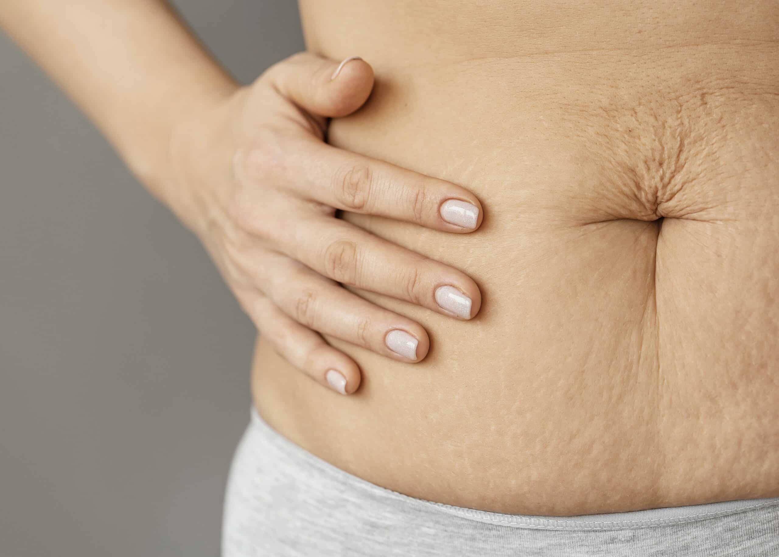 Stretch Mark Treatment: Solusi Efektif untuk Menyamarkan Garis pada Kulit