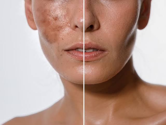 Instabrite Treatment