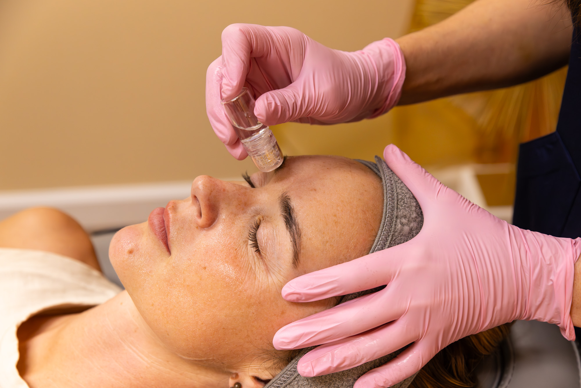 Microinfusion Facial