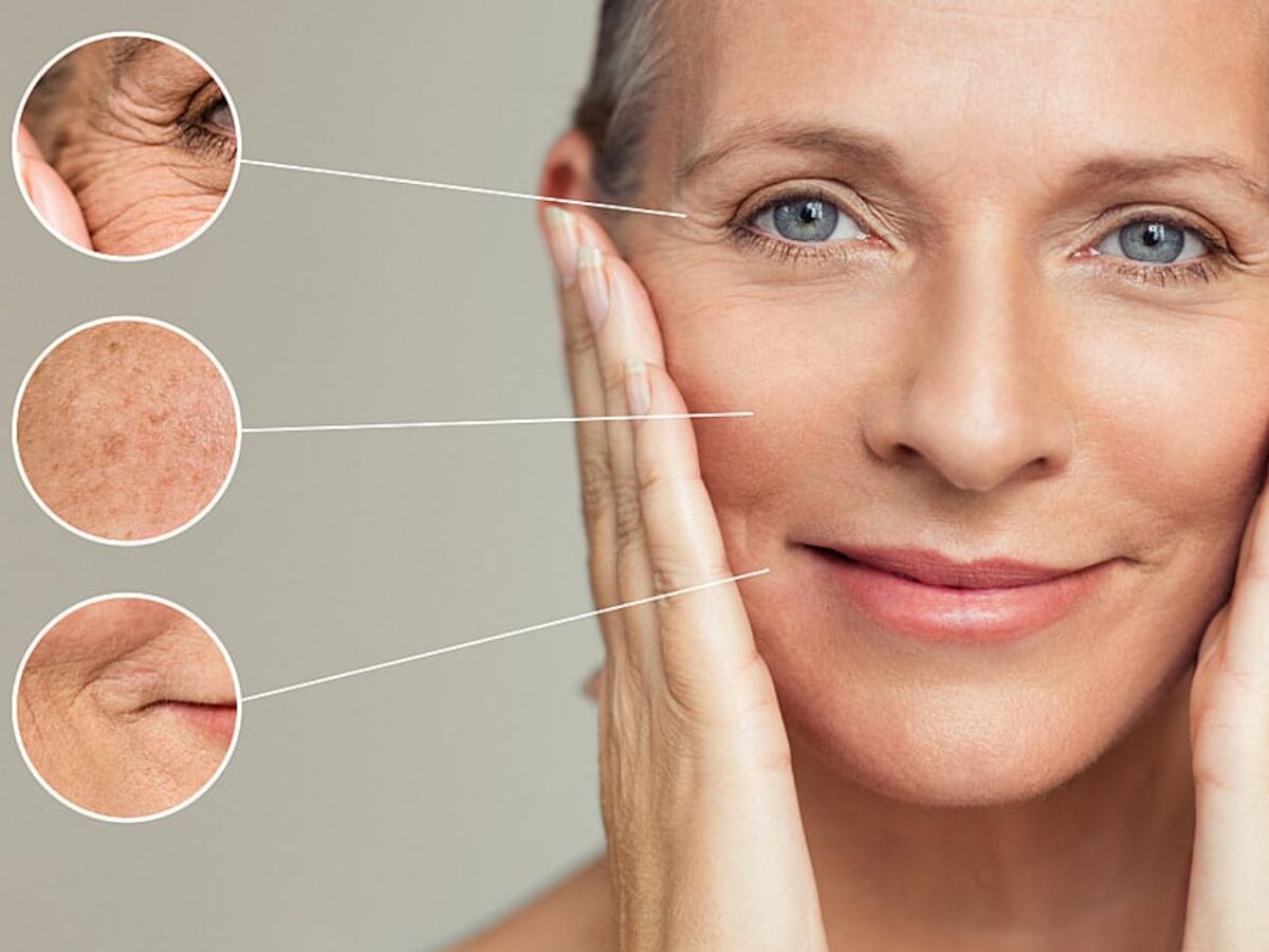 Profhilo Treatment