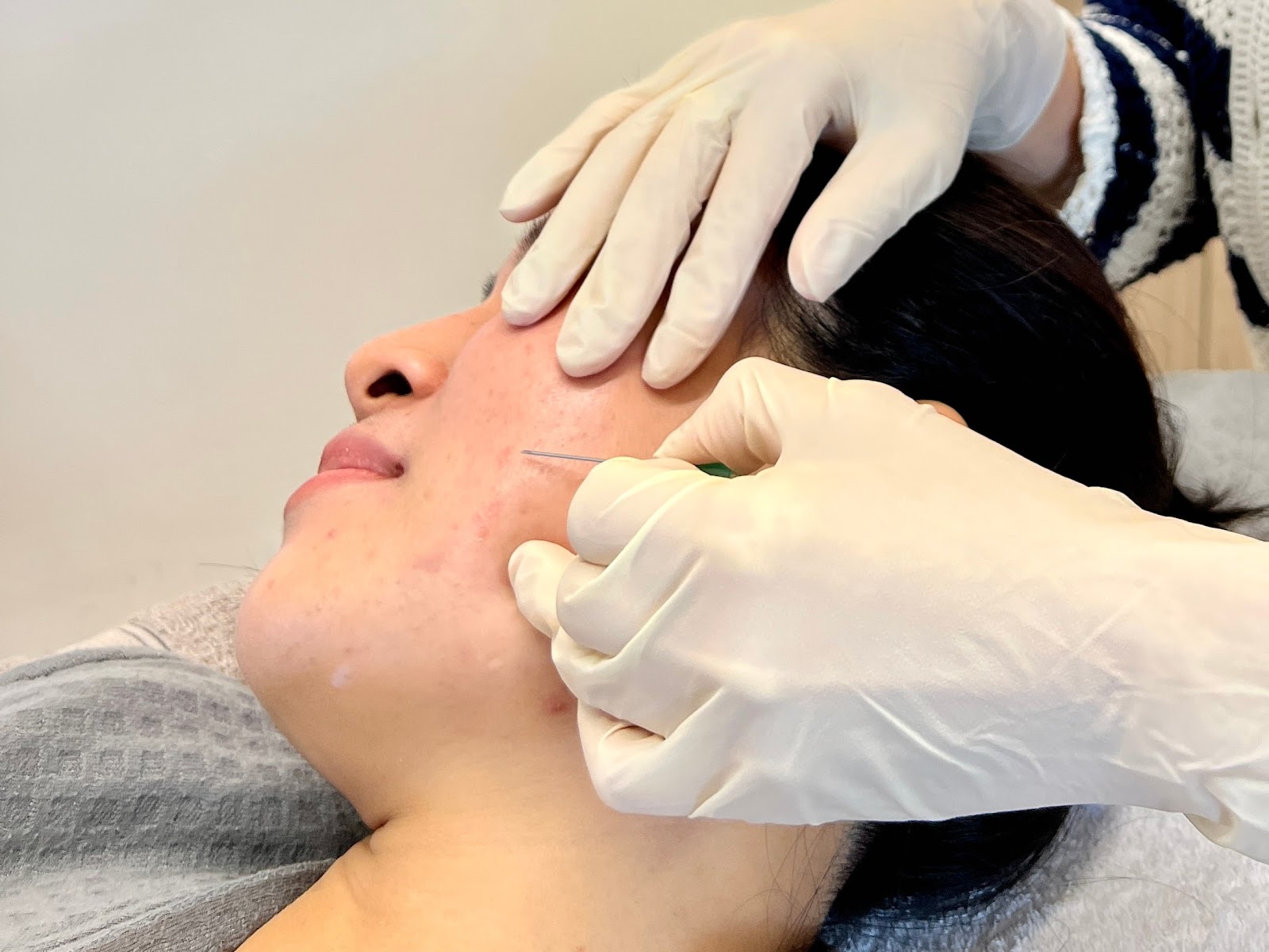 Scars Treatment