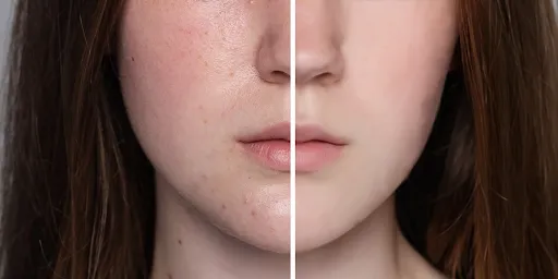 Dry Skin
