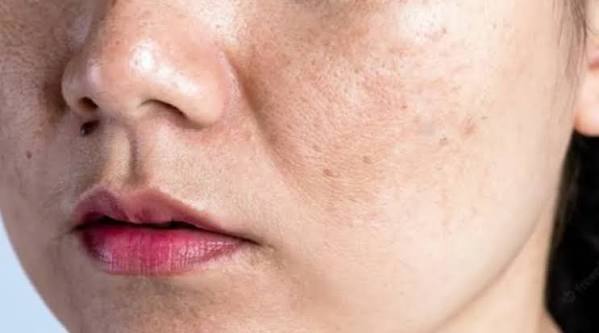 Kulit Kusam Bikin Wajah Kurang Segar? Kenali Solusinya