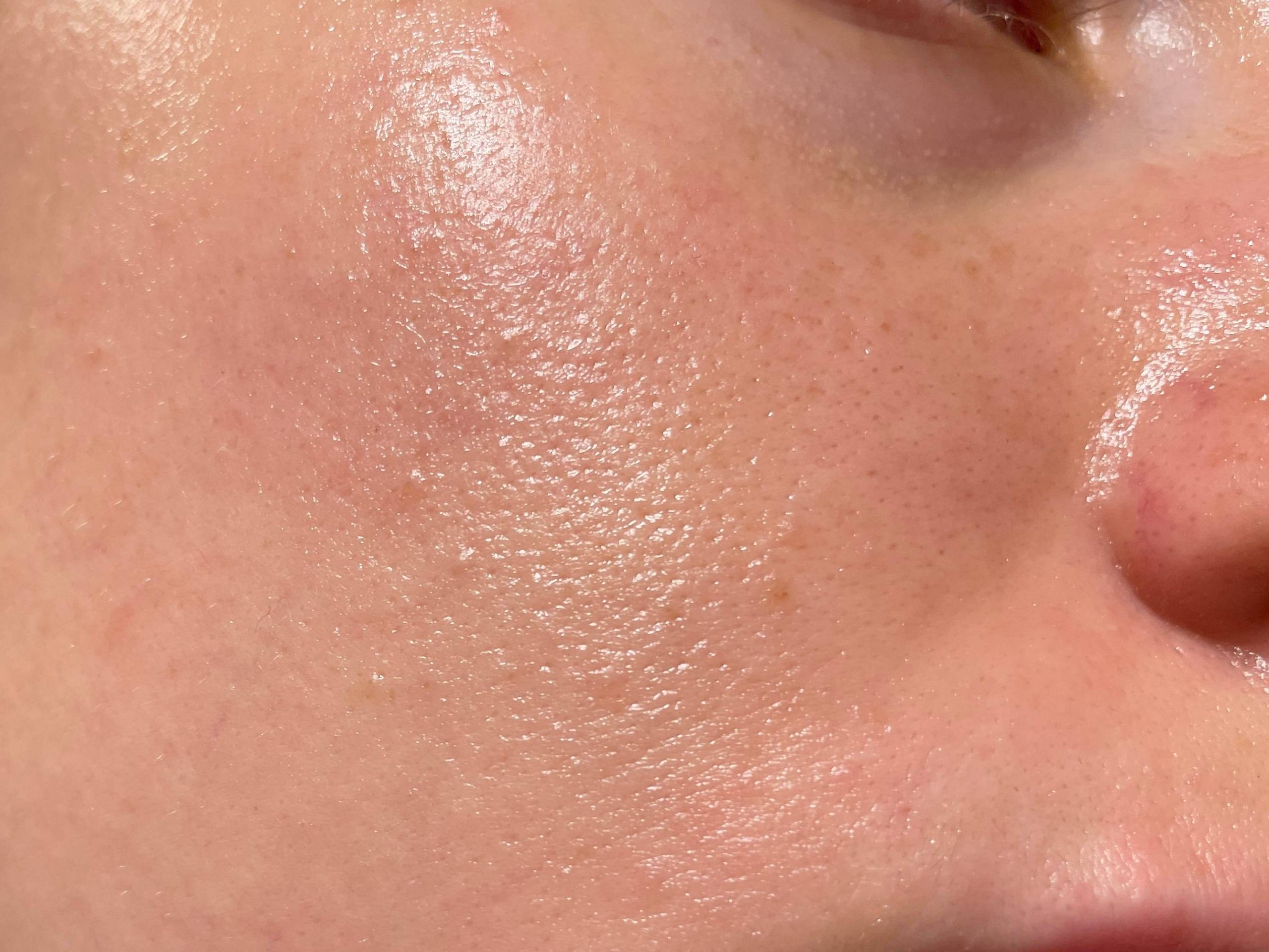 Oily Skin