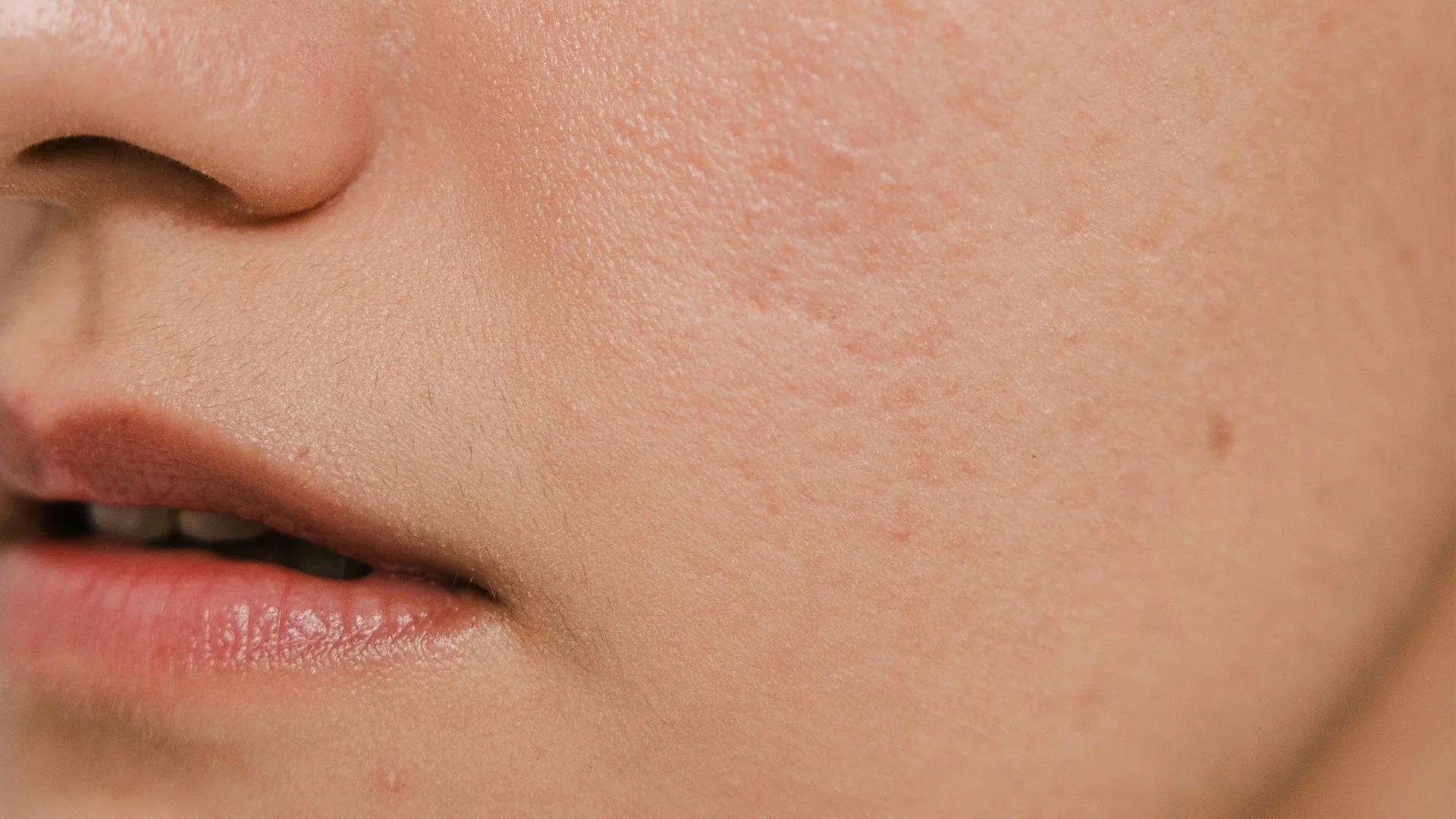 Skin Barrier