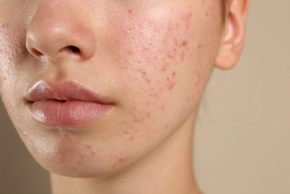 Skin Barrier